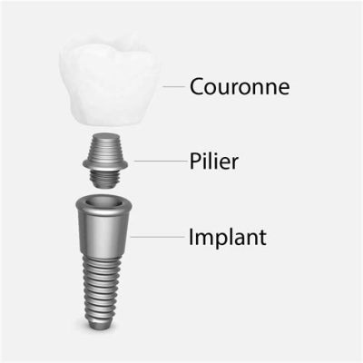 Titane: La star incontournable des implants orthopédiques et de l'aéronautique ultra-légère!